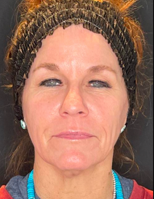 Sculptra after