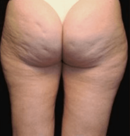 Cryoskin Toning before