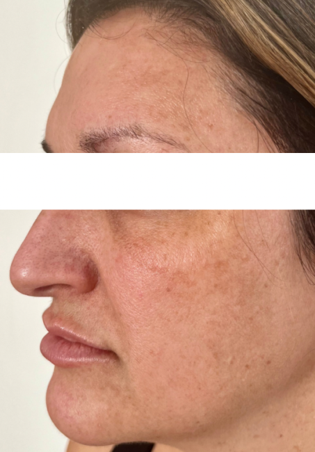 IPL Photorejuvenation after
