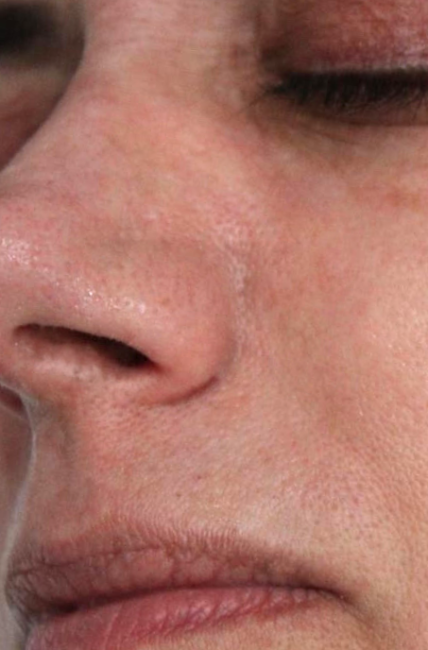 YAG Laser Vein Therapy after