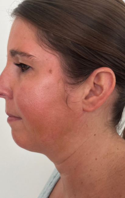 CoolSculpting after