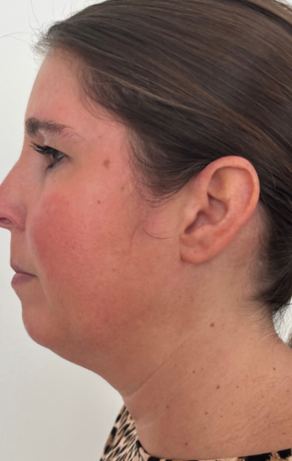 CoolSculpting before
