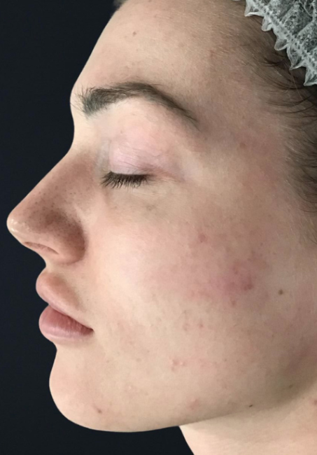 Acne Clearing Program after