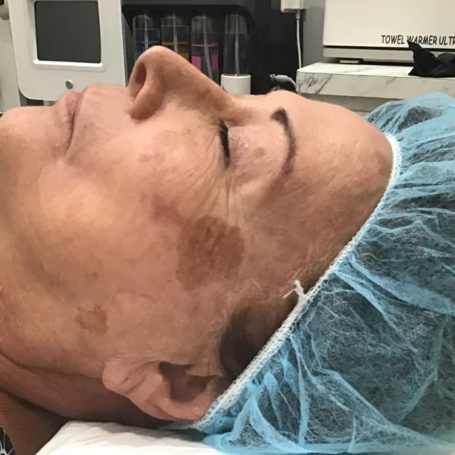 Fraxel Laser before