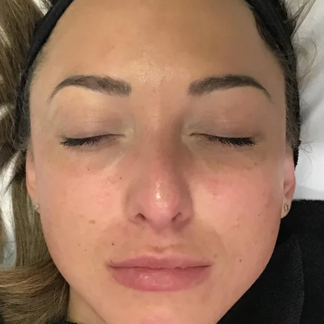 Dermaplane after
