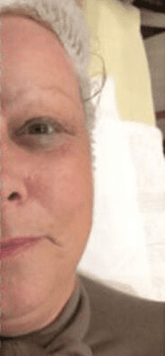 Cryoskin Facial after
