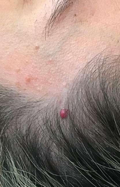 Cherry Angioma Removal before