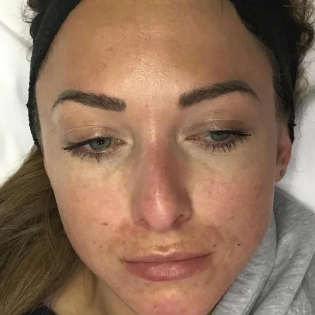 Dermaplane before