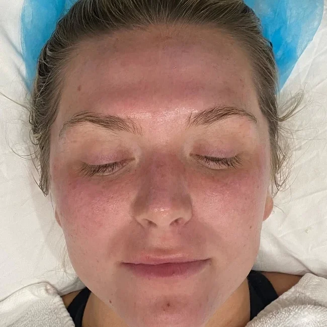 Microdermabrasion before