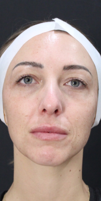 Laser Treatment before