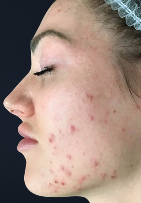 Acne Clearing Program before