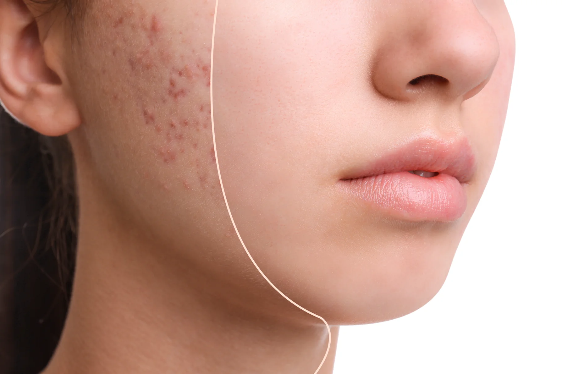 Treatments To Help Reduce Acne Scarring