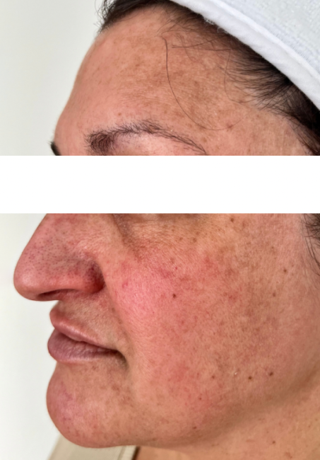 IPL Photorejuvenation before