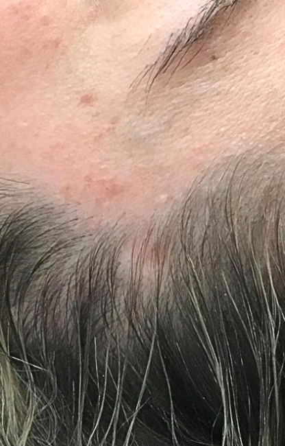 Cherry Angioma Removal after