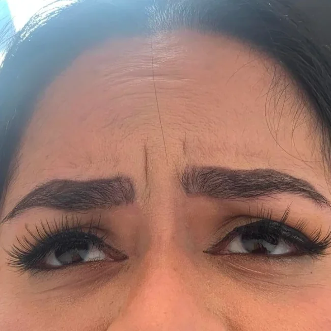 Botox before