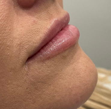 Dermal Fillers before