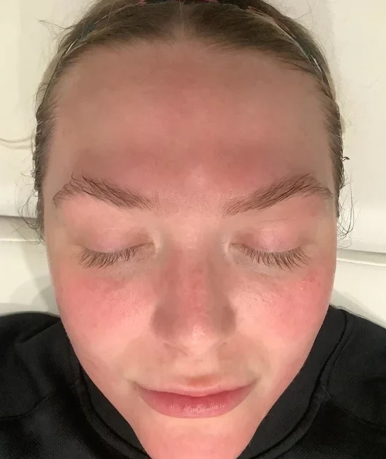 Microdermabrasion after