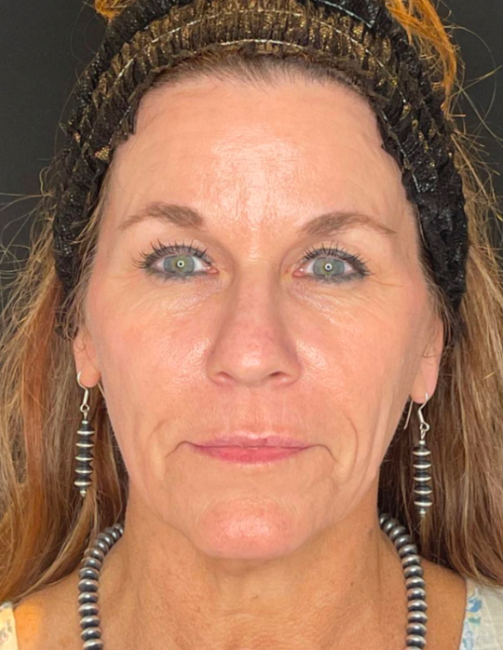 Sculptra before