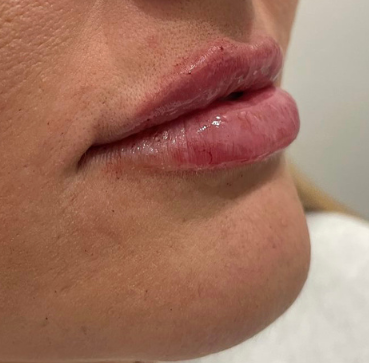 Dermal Fillers after