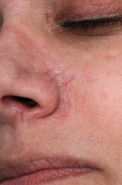 YAG Laser Vein Therapy before