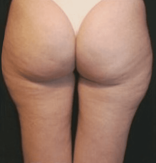 Cryoskin Toning after