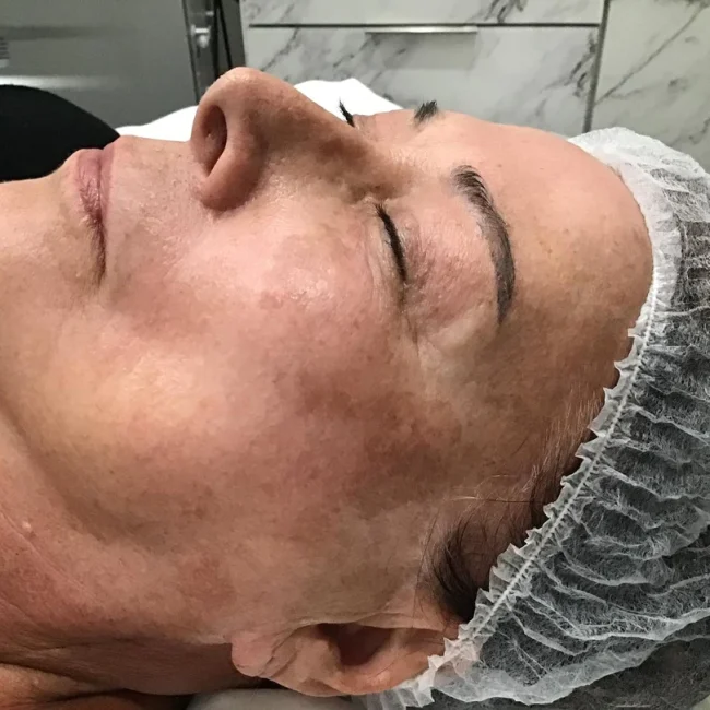 Fraxel Laser after