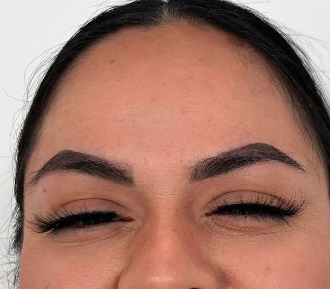 Botox after